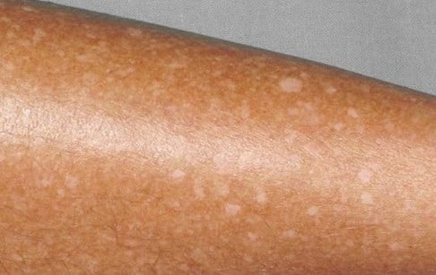 Leucodermia gutata tratamento: sarda branca tem cura?