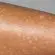 Leucodermia gutata (sardas brancas): prevenção é o melhor remédio