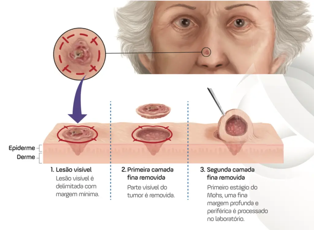 Como é feita a cirurgia de Mohs