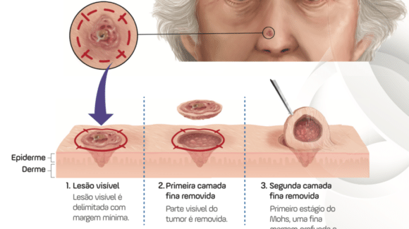 Cirurgia de Mohs: o que é e para que serve?