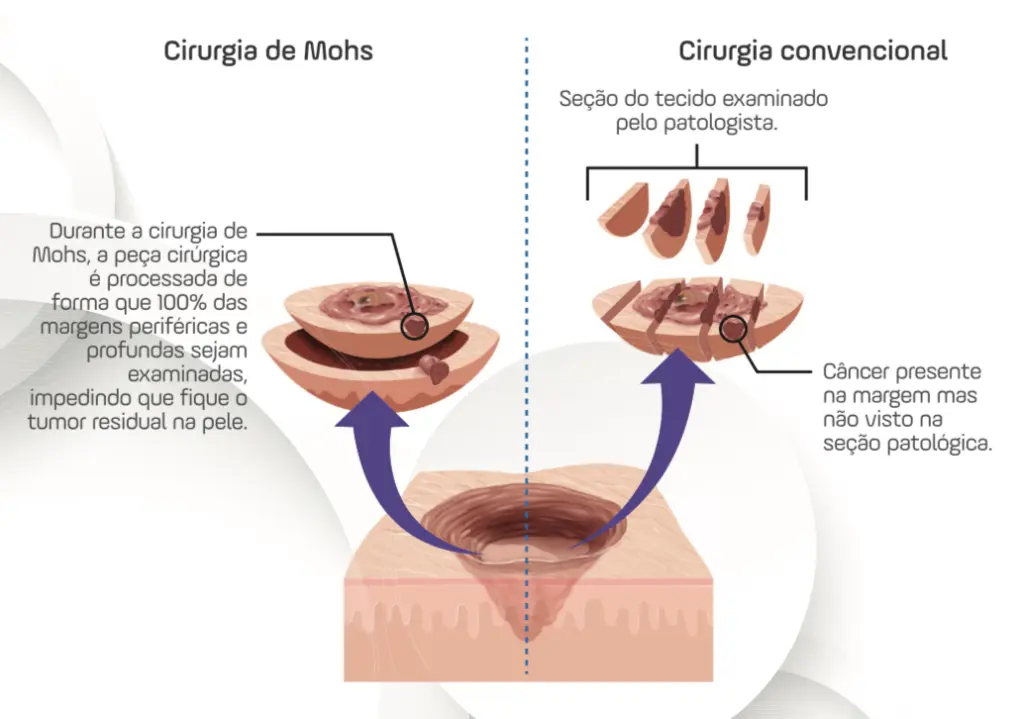 Diferença entre cirurgia de Mohs e convencional