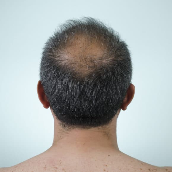 Alopecia: conheça suas características e definição Alopecia: conheça suas características e definição