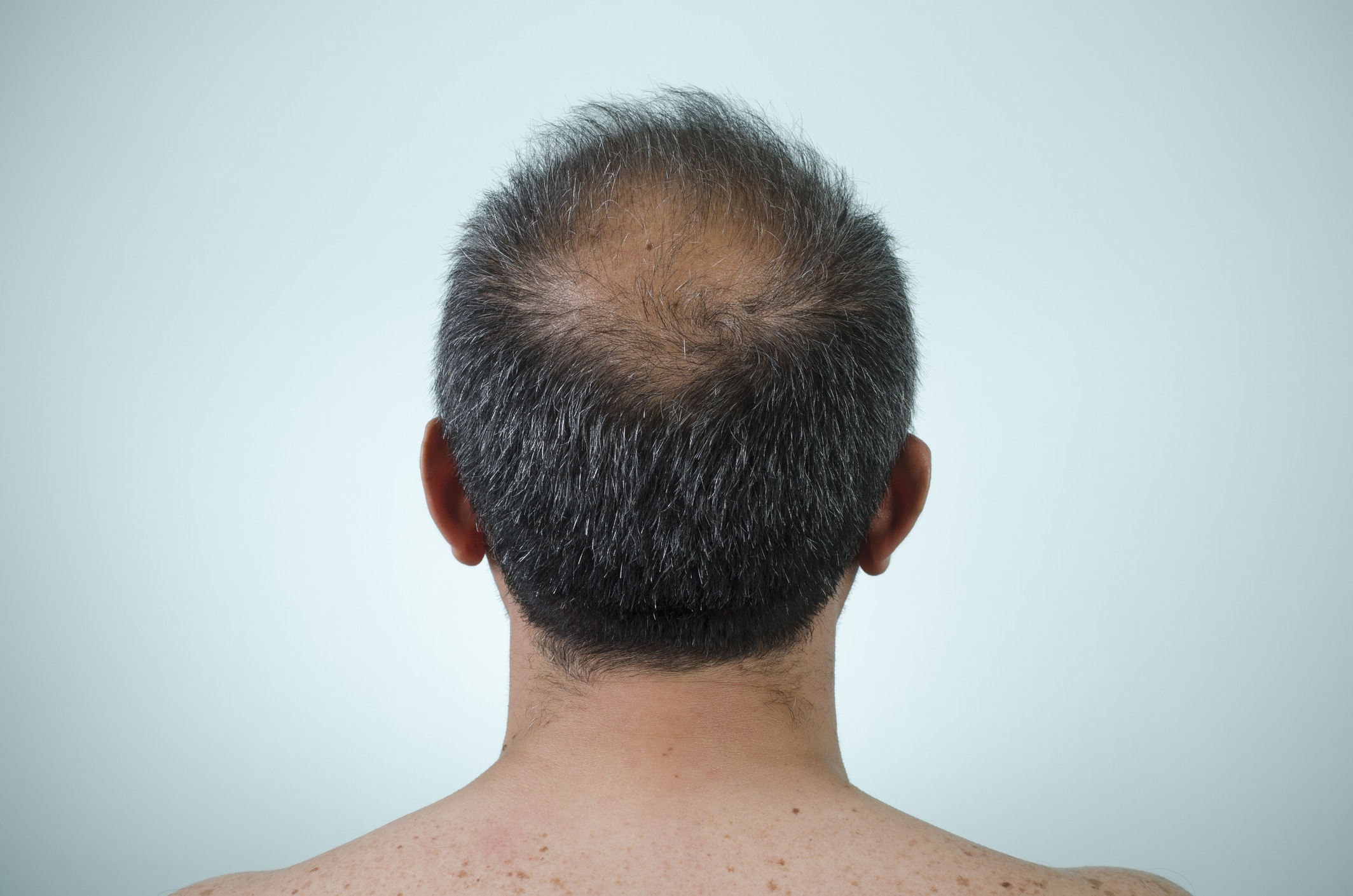 Alopecia ou perda de cabelo