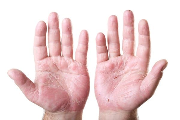 Bolhas nas mãos e pés pode ser sintomas da Disidrose - Disidrose: Causas, sintomas e tratamento - Dermacenter Alto Vale