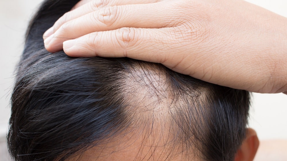 Alopecia Areata: o que é, diagnóstico e tratamento 