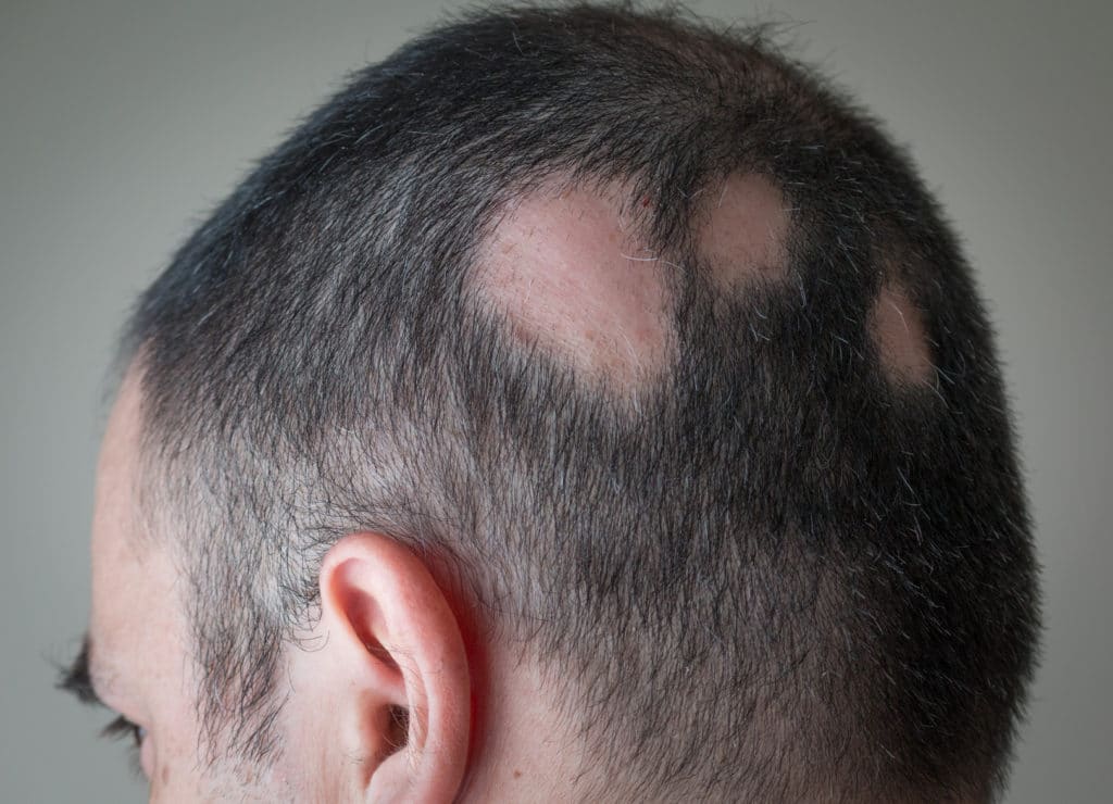 Alopecia Areata: o que é, diagnóstico e tratamento 