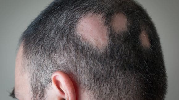 Alopecia Areata: o que é, diagnóstico e tratamento
