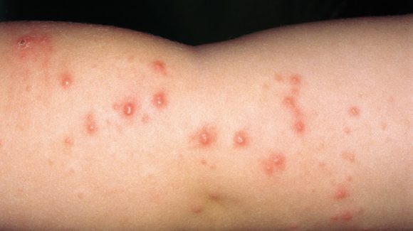 Dermatite Herpetiforme: Diagnóstico e tratamentos