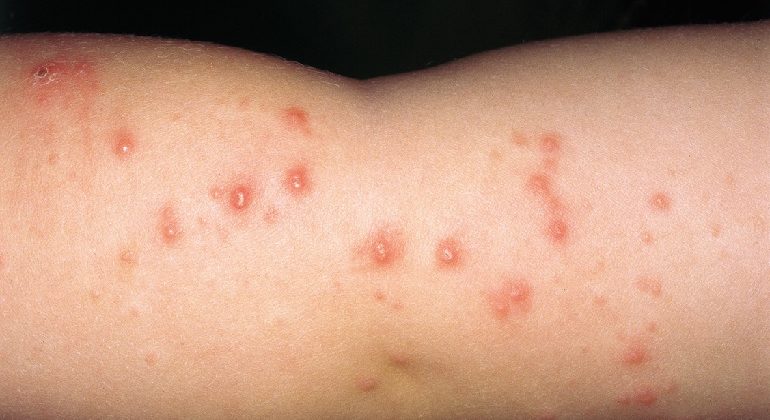 Dermatite Herpetiforme: Diagnóstico e tratamentos