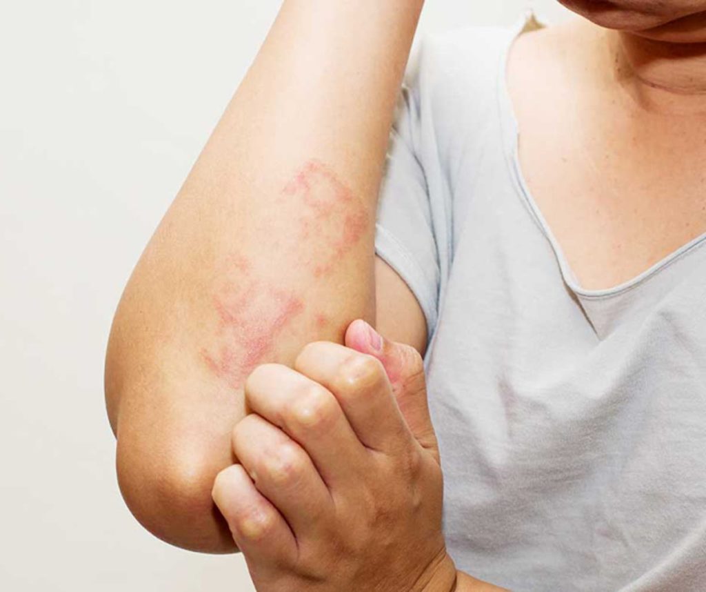 Dermatite Atópica: conheça os sintomas e tratamentos