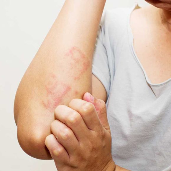 Coceira no corpo em Rio do Sul: quando procurar dermatologista