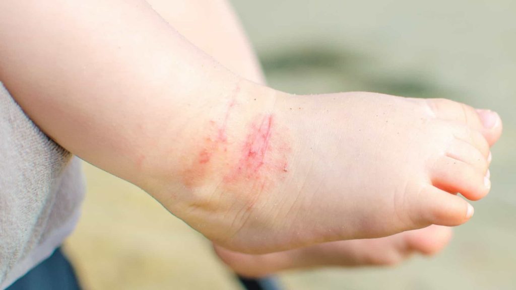 Dermatite Atópica: conheça os sintomas e tratamentos 