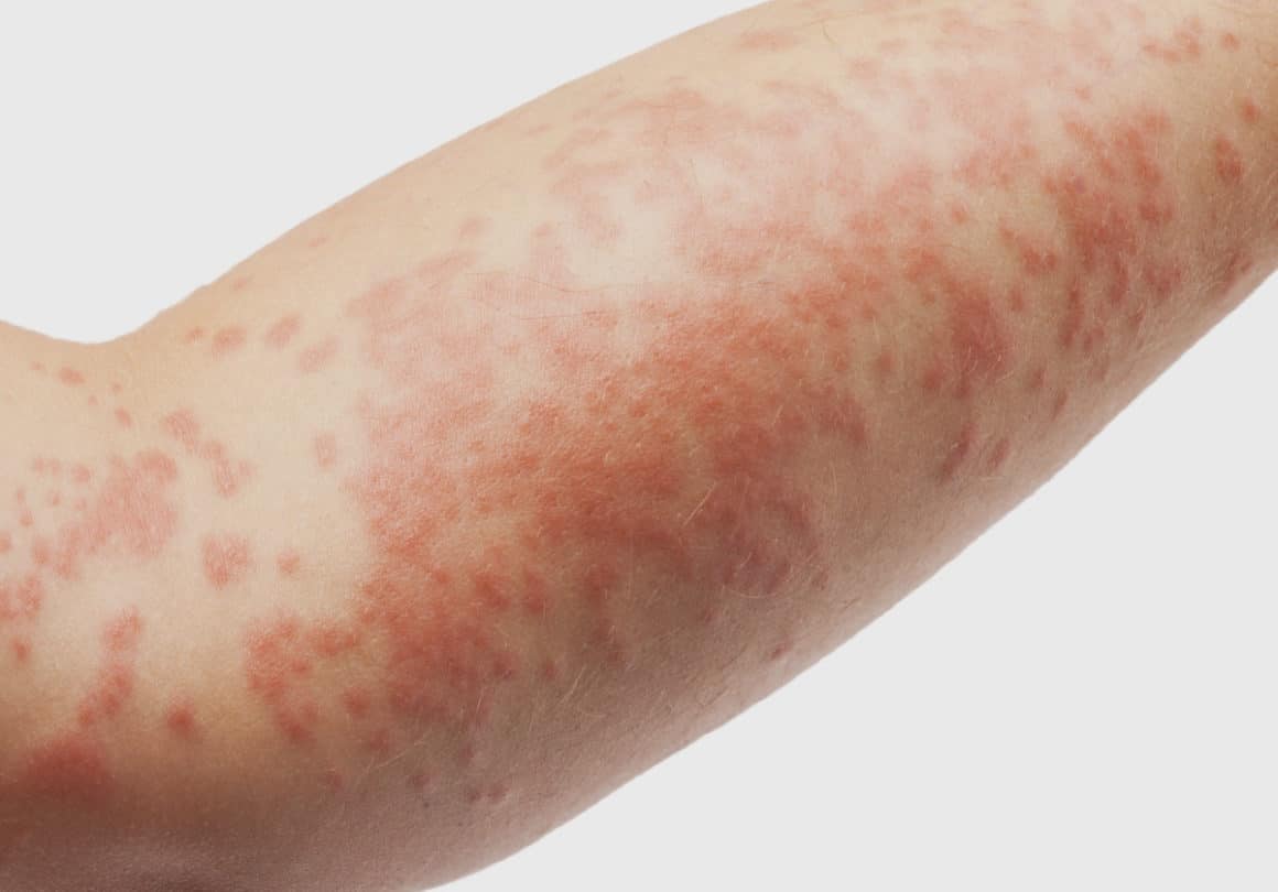 Dermatite Atópica: conheça os sintomas e tratamentos - Dermacenter Alto ...