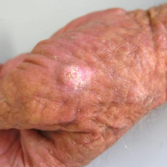 Carcinoma Espinocelular: sintomas, diagnóstico e tratamento Carcinoma Espinocelular: sintomas, diagnóstico e tratamento
