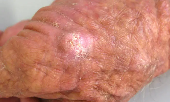 Carcinoma Espinocelular: sintomas, diagnóstico e tratamento
