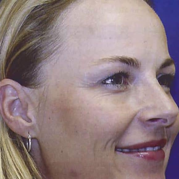 O efeito preventivo da toxina botulínica a médio e longo prazo O efeito preventivo da toxina botulínica a médio e longo prazo