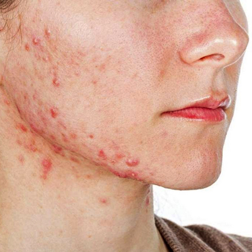 Isotretinoína: entenda a ação do medicamento no tratamento da acne