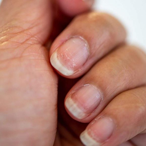 Síndrome das unhas frágeis: o que causa e como tratar o enfraquecimento das unhas?