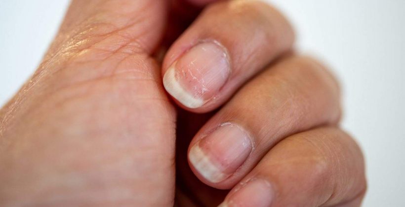 Síndrome das unhas frágeis: o que causa e como tratar o enfraquecimento das unhas?