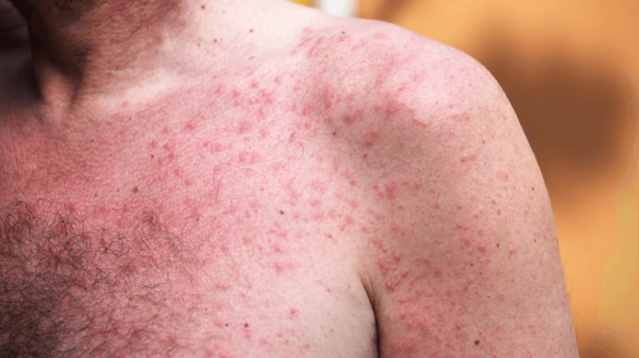 Doenças de pele mais comuns no verão: saiba quais são e como evitar