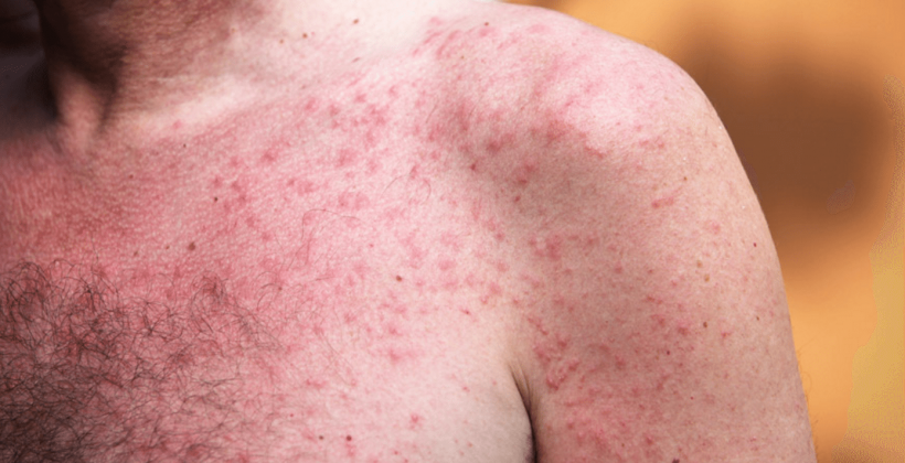 Doenças de pele mais comuns no verão: saiba quais são e como evitar