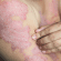 Psoríase em Rio do Sul: onde tratar com dermatologista especializado
