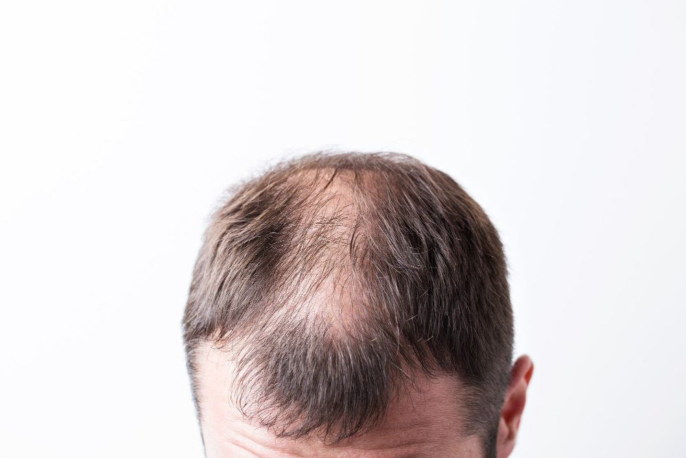 close-up-balding-head-young-man-white-isolated-background