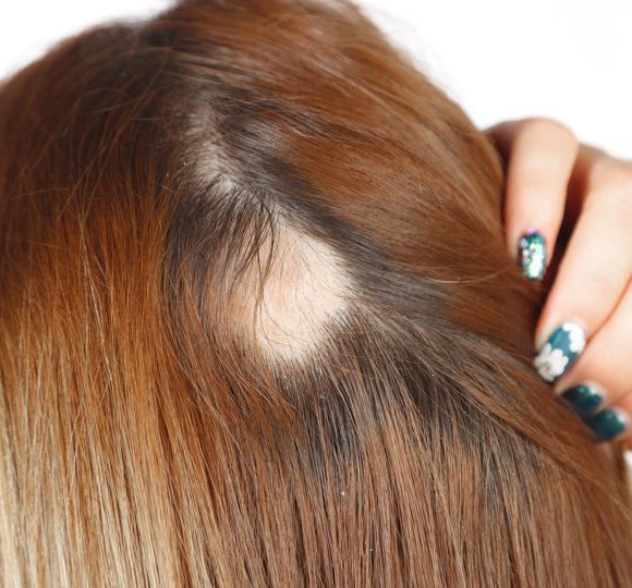 Cabelo caindo muito: até quando pode ser normal?
