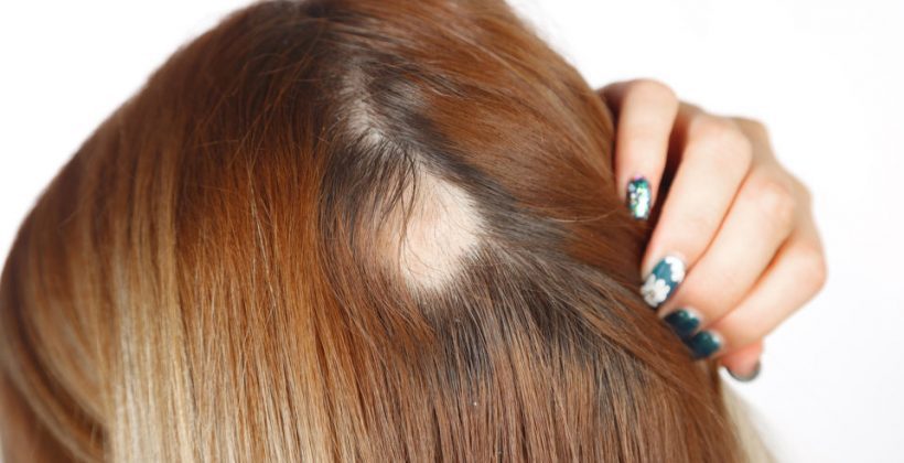 Cabelo caindo muito: até quando pode ser normal?