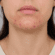 Acne da mulher adulta: o que é, por que acontece e como tratar