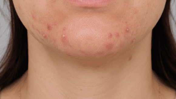 Acne da mulher adulta: o que é, por que acontece e como tratar Acne da mulher adulta: o que é, por que acontece e como tratar