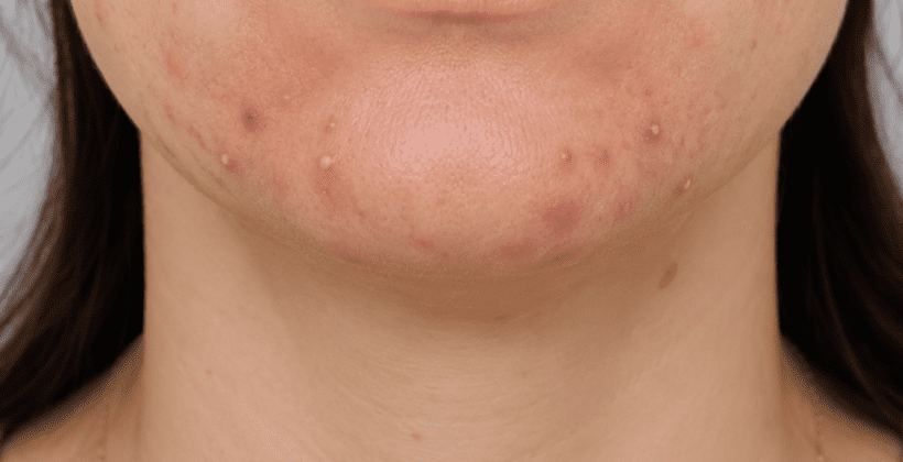 Acne da mulher adulta: o que é, por que acontece e como tratar Acne da mulher adulta: o que é, por que acontece e como tratar