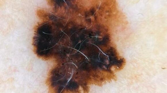 Melanoma: o que é, sintomas, diagnóstico e tratamento Melanoma: o que é, sintomas, diagnóstico e tratamento