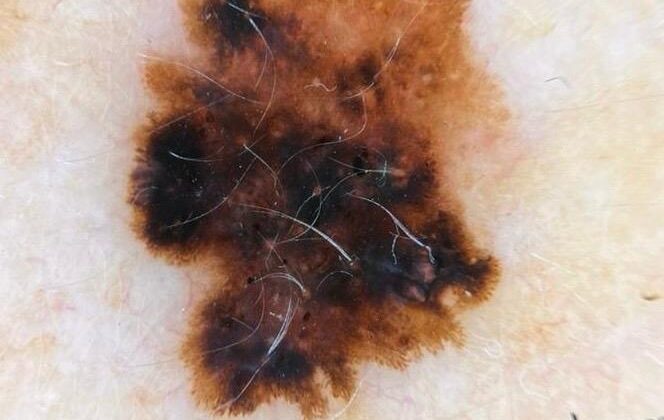 Melanoma: o que é, sintomas, diagnóstico e tratamento