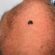 Melanoma nodular: o tipo que pode crescer rápido e parecer uma lesão comum