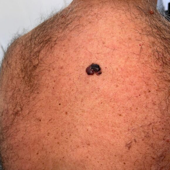 Melanoma nodular: o tipo que pode crescer rápido e parecer uma lesão comum