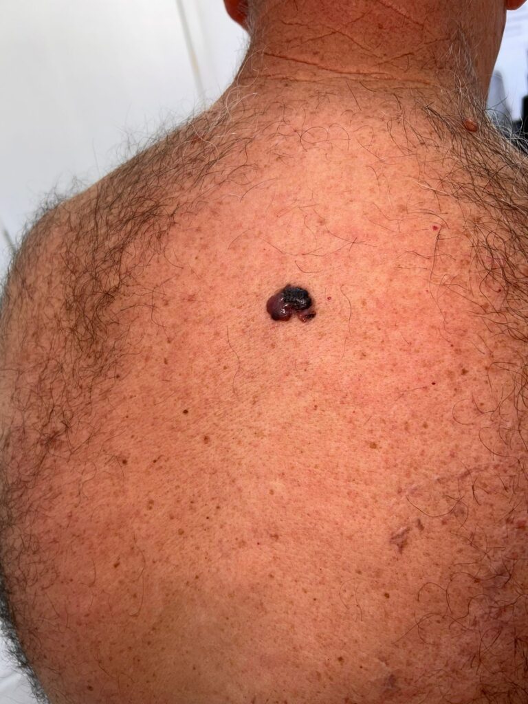 Lesão nodular escura e elevada no dorso, usada para ilustrar sinais clínicos de alerta do melanoma nodular.