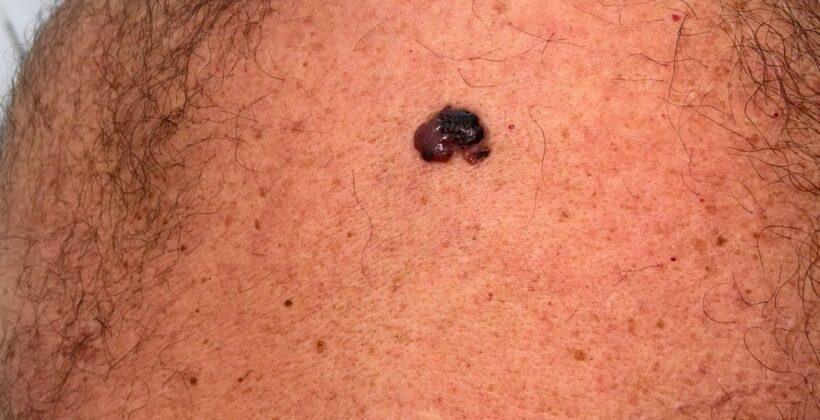 Melanoma nodular: o tipo que pode crescer rápido e parecer uma lesão comum Melanoma nodular: o tipo que pode crescer rápido e parecer uma lesão comum
