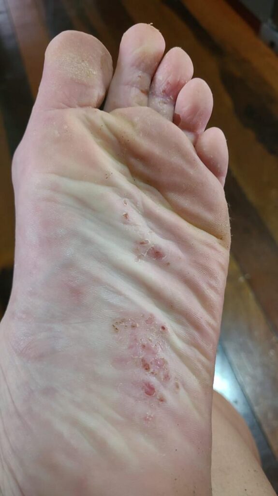 Imagem clínica de tinea pedis na planta do pé, com descamação, fissuras e áreas avermelhadas sugestivas de micose nos pés.
