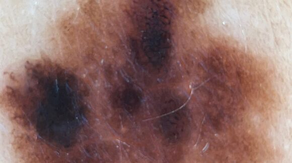 Regra ABCDE do melanoma: como avaliar uma pinta suspeita? Regra ABCDE do melanoma: como avaliar uma pinta suspeita?