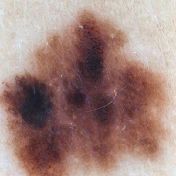 Regra ABCDE do melanoma: como avaliar uma pinta suspeita?