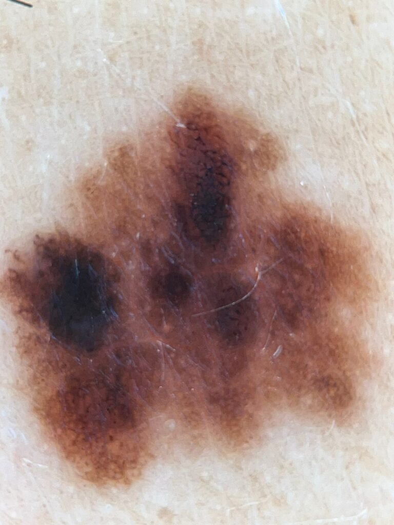 Imagem dermatoscópica de pinta suspeita com assimetria, bordas irregulares e variação de cores, usada para ilustrar a regra ABCDE do melanoma.