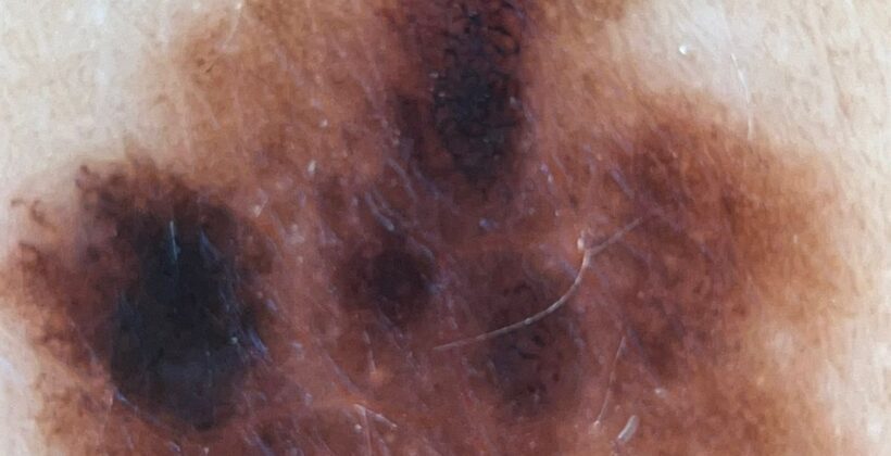 Regra ABCDE do melanoma: como avaliar uma pinta suspeita?