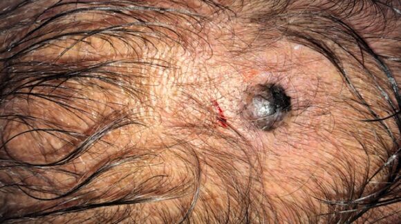 Melanoma do couro cabeludo: sinais, riscos, diagnóstico e tratamento Melanoma do couro cabeludo: sinais, riscos, diagnóstico e tratamento