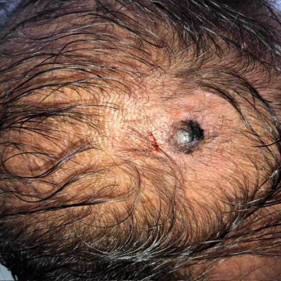 Melanoma do couro cabeludo: sinais, riscos, diagnóstico e tratamento