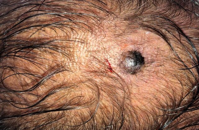 Melanoma do couro cabeludo: sinais, riscos, diagnóstico e tratamento