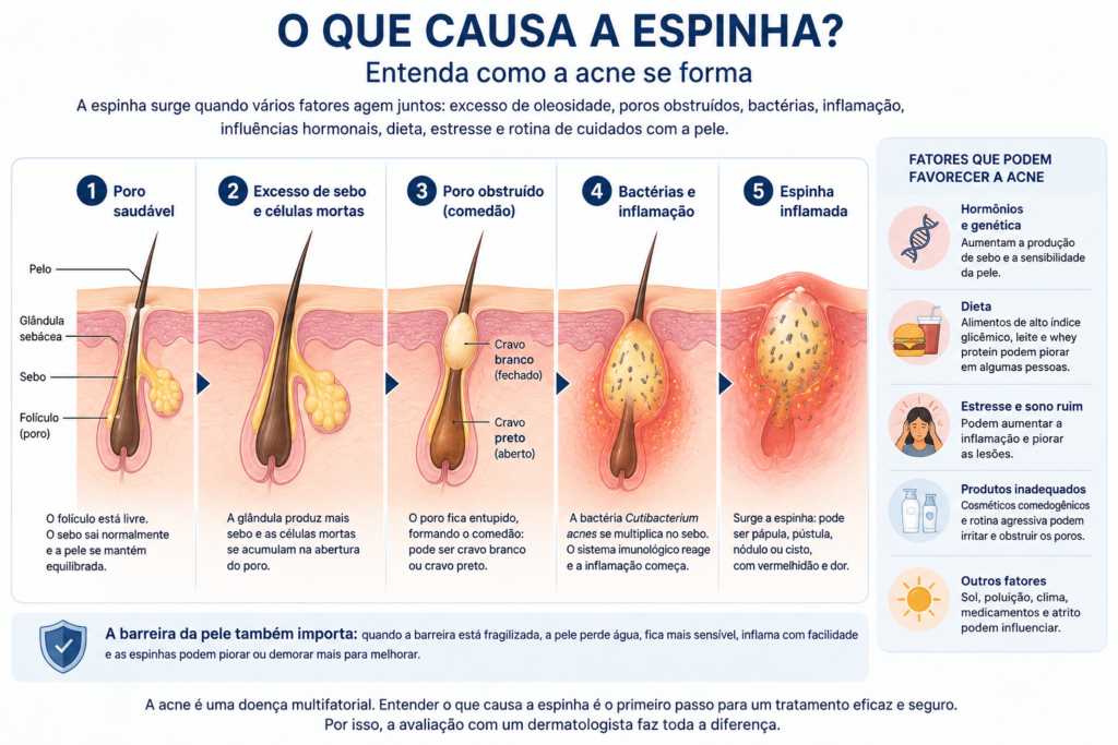 Infográfico explicando o que causa a espinha, mostrando a formação da acne a partir do excesso de sebo, células mortas, poro obstruído, bactérias e inflamação.