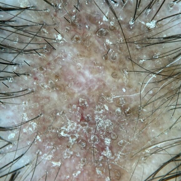 Tricologista Rio do Sul: avaliação médica para queda de cabelo e saúde capilar