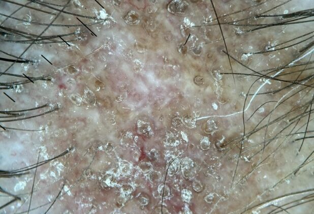 Tricologista Rio do Sul: avaliação médica para queda de cabelo e saúde capilar Tricologista Rio do Sul: avaliação médica para queda de cabelo e saúde capilar