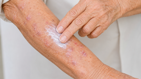 Efurix: o que é, para que serve e como é a evolução do tratamento